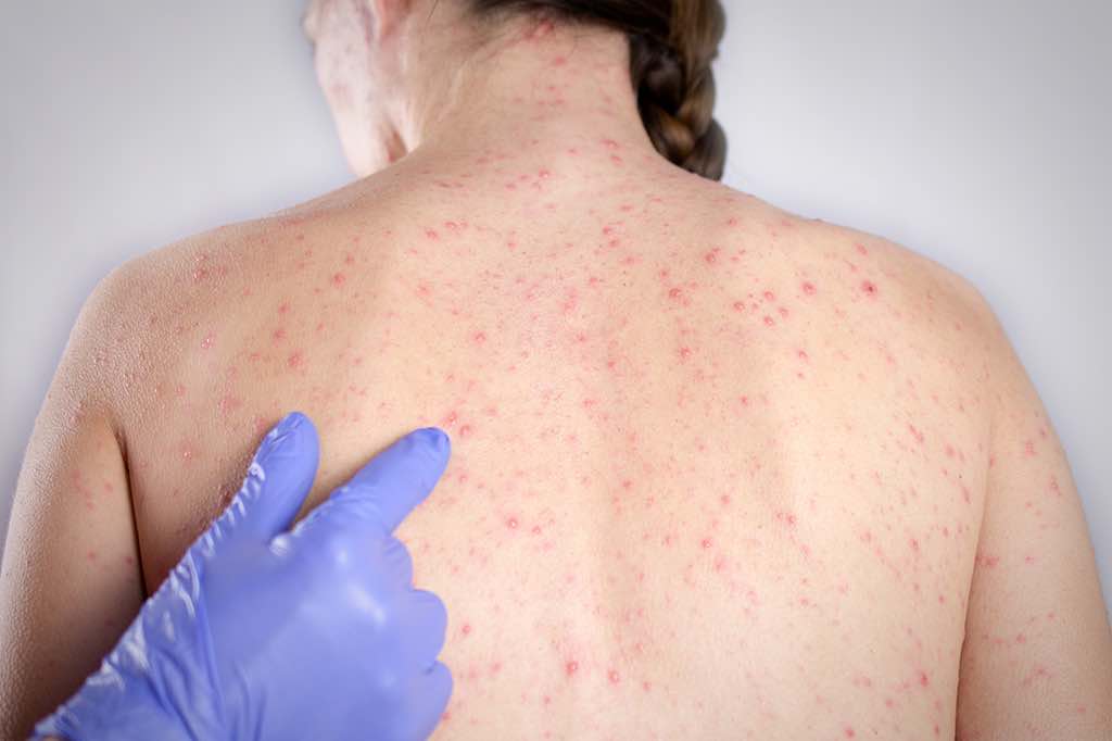 measles image